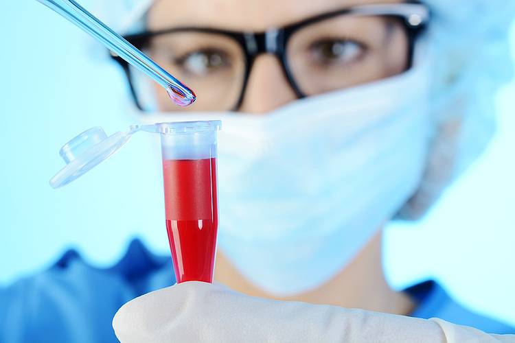 Labormedizinerin untersucht eine Blutprobe auf Blutkrebs.
