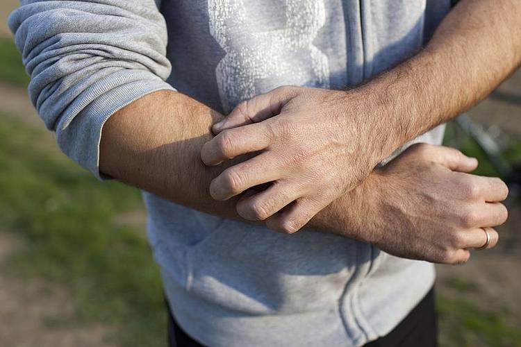 Mann im grauen Sweatshirt kratzt sich aufgrund einer  Schuppenflechte am Arm.