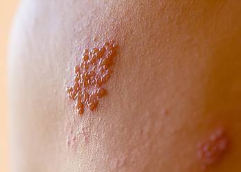 Haut mit Herpes zoster-Viren (Gürtelrose).